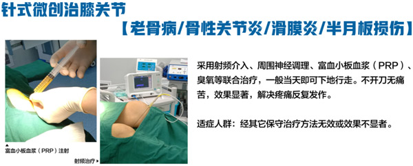 常见关节炎类型详解:类风湿性关节炎,痛风性关节炎,骨关节炎,急性感染性化脓性关节炎