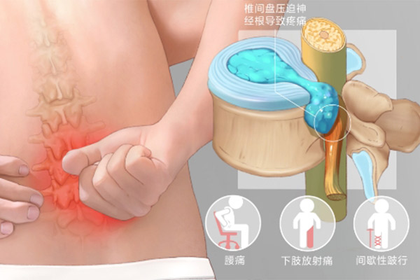 腰间盘突出最让人纠结的问题:是保守治疗还是手术?要看具体情况